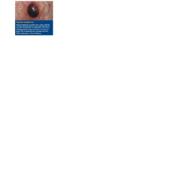 Gambar 6. Nodular melanoma