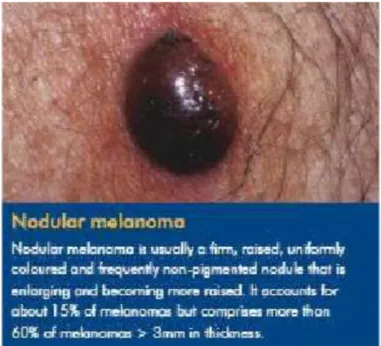 Gambar 6. Nodular melanoma