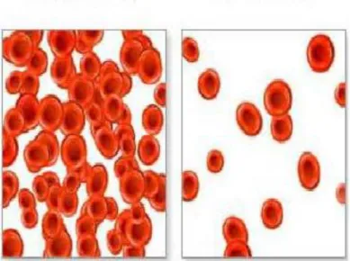 Gambar 2. Sel darah merah dalam keadaan normal (kiri), manakala  gambaran sel  darah  merah yang mengalami anemia (kanan)