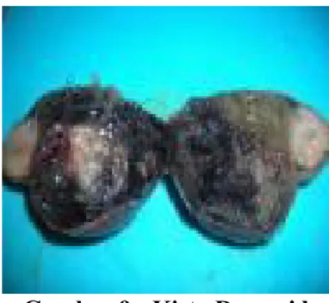 Gambar 9 : Kista Dermoid 1.2.Solid