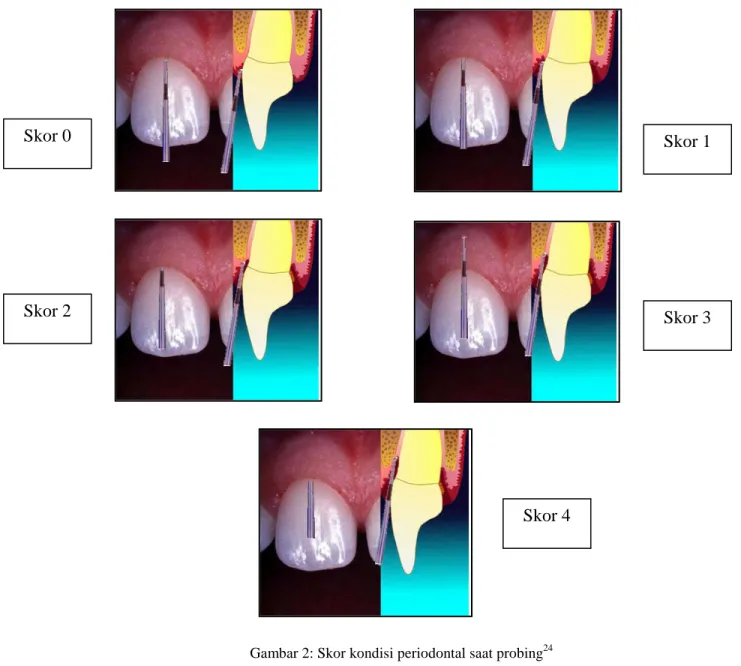 Gambar 2: Skor kondisi periodontal saat probing 24
