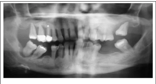 Gambar 1. Radiografi panoramik menunjukkan adanya kehilangan tulang  akibat periodontitis kronis