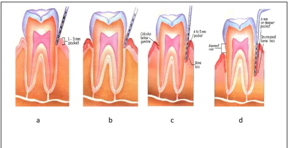Gambar 2.  Tahapan penyakit periodontal 19 a. Gingiva normal  