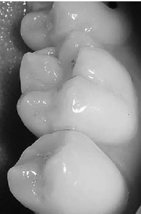 Gambar 2.4 Celah atau fisura gigi dapat menjadi lokasi karies  b)  Karies permukaan halus 