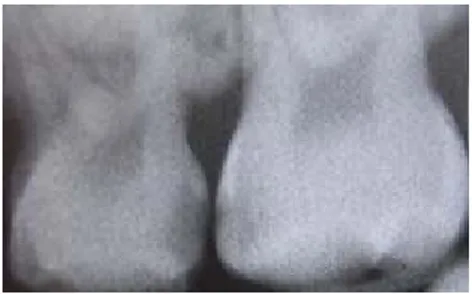 Gambar 2.5 Titik hitam pada batas gigi menunjukkan sebuah karies  proksima 