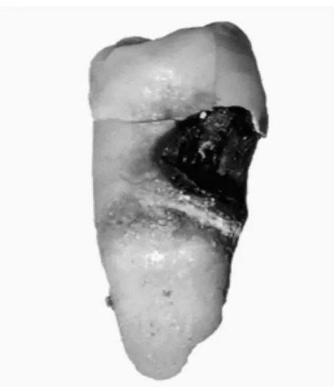 Gambar 2.2 Kerusakan gigi berupa lubang yang disebabkan karies 
