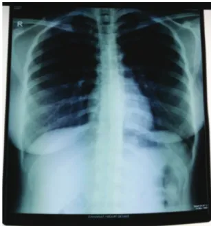Gambar 1   Perkembangan status pneumotoraks spontan pasien  berdasarkan gambaran radiologi toraks Postero-Anterior (PA)