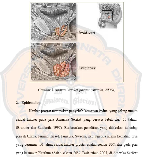 Gambar 3. Anatomi kanker prostat (Anonim, 2006a) 