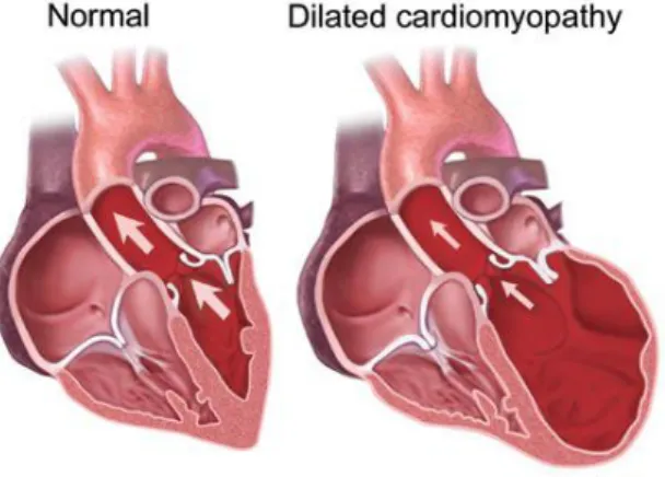 Gambar 1. Jantung normal dibandingkan dengan jantung pasien kardiomiopati dilatasi  10