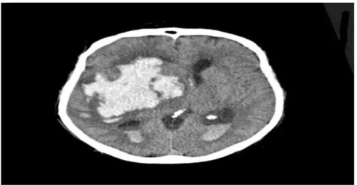 Gambar 1. Head CT Scan pada pasien perdarahan intraserebral 