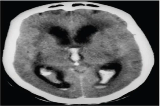 Gambar 2. Perdarahan intraventrikular pada Head CT scan 