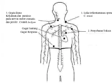 Gambar 5  Patogenesis penyakit tetanus (Anonim 2003). 