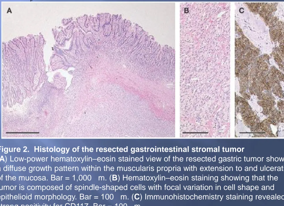 Figure 2. Histology of the resected gastrointestinal stromal tumor
