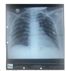 Foto rontgen dada pada hari ketiga  menunjukkan  pengurangan  bermakna  infiltrat  pada kedua lapangan paru (Gambar 2) dan rasio  kardiotoraks sebesar 60%