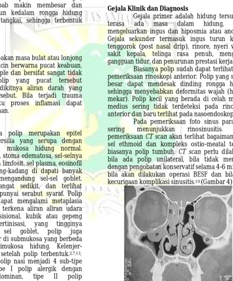 Gambar  4.  This  sinus  CT  scan  shows  polyps.  There  is  obstruction  of  the  ostium  (maxillary  sinus  ostium)