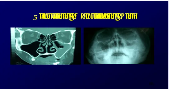 Gambar 2. Gambaran Foto Waters dan CT Scan potongan koronal yang  memperlihatkan sinusitis maksilaris