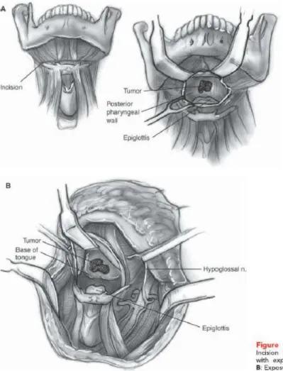 Gambar 5.2  Suprahyoid Pharyngotomy 
