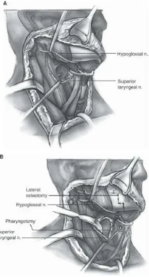 Gambar 5.3  Lateral Pharyngotomy 