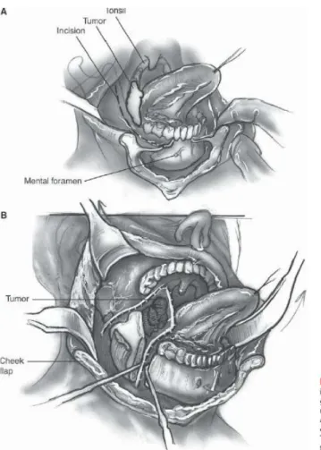 Gambar 5.6  Mandibulectomy 