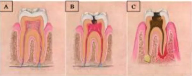 Gambar 1 Ilustrasi keadaan gigi yang mengalami infeksi dapat menyebabkan abses odontogen.(A)  Gigi normal, (B) gigi mengalami karies, (C) gigi nekrosis yang mengalami infeksi menyebabkan 