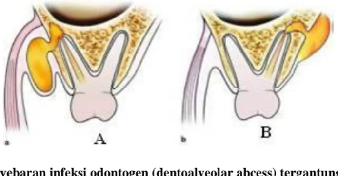 Gambar 2 Ilustrasi penyebaran infeksi odontogen (dentoalveolar abcess) tergantung pada posisi apeks gigi  penyebab