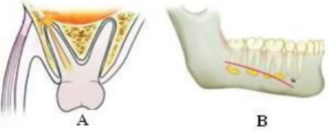 Gambar 3 Ilustrasi penyebaran infeksi odontogen (dentoalveolar abcess) tergantung pada posisi  apeks gigi penyebab.(A) Penyebaran pus kea rah sinus maksilaris (B) Penyebaran pus pada rahang 