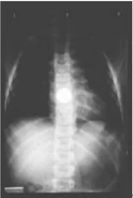 Gambar 2.4. Koin berada pada tingkat sfingter esofagus bawah (Munter, 2014) 