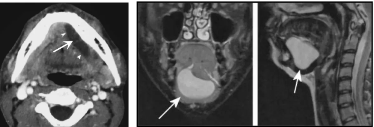 Gambar 2.12   Gambaran radiografi                            ranula (CT Scan),                            ditunjukkan oleh                            tanda panah 4