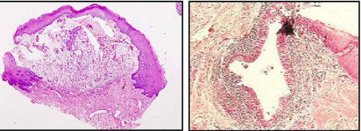 Gambar 2.6    Gambaran histopatologi mukokel                   tipe ekstravasasi mukus yang  