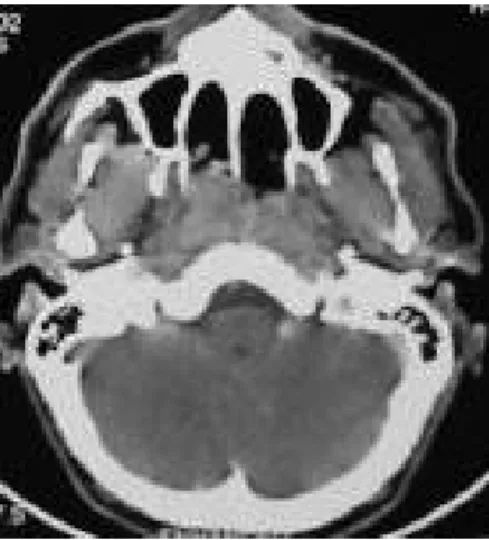 Gambar  7.  Gambaran  CT  scan  tanpa  kontras  menunjukkan  penebalan  dinding  parafaringeal lateral kanan