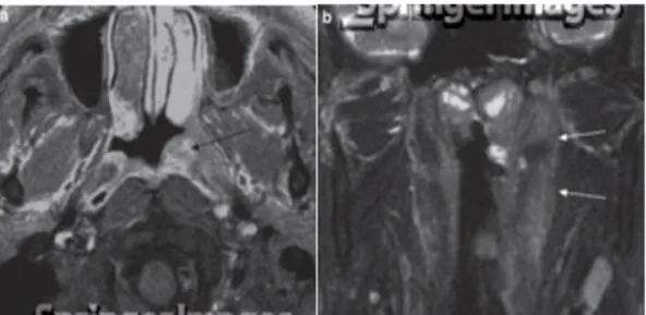 Gambar  10.  Angiofibroma.  CT  scan  menunjukkan  dinding  posterior  sinus  maxillaris menonjol ke anterior