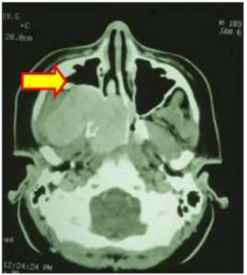 Gambar 3. Gambaran Holman Miller CT Scan  7.  Diagnosis 