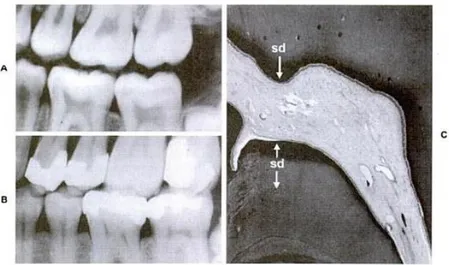 Gambar 4. Perubahan radiografik pada kamar pulpa. 