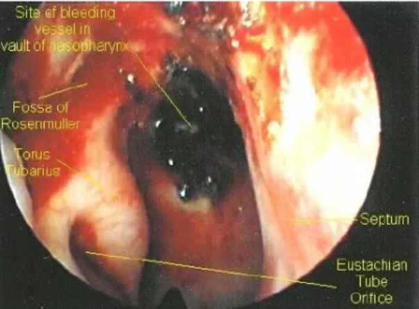 Gambar 8 - Gambaran endoskopi pada epistaksis posterior  (dikutip dari Viewhug, TL, Jhon BR, 2006) 