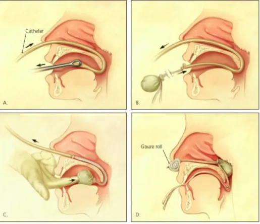 Gambar 10 - Posterior nasal packing/Tampon hidung posterior  (dikutip dari  Kucik,CJ, Timothy C,2005) 