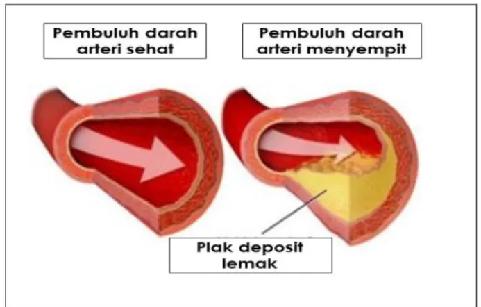 Gambar 10.  Menyempitnya pembuluh darah di jantung  dikarenakan deposit plak. Sumber : satuproteksi.com