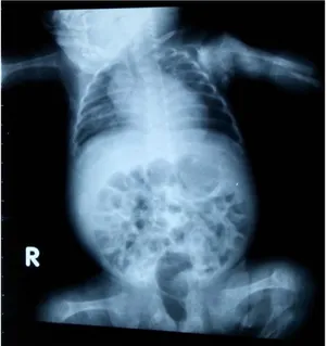 Gambar 1.2 Rontgen thorax DBP 
