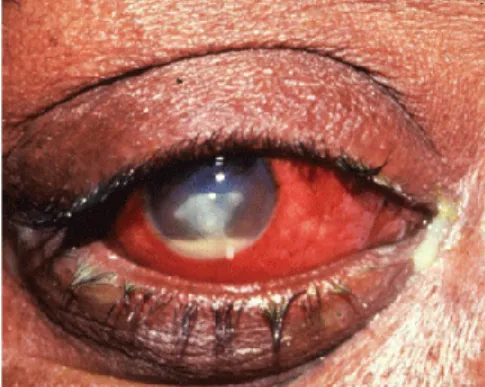 Gambar 9. Keratitis Kornea 26