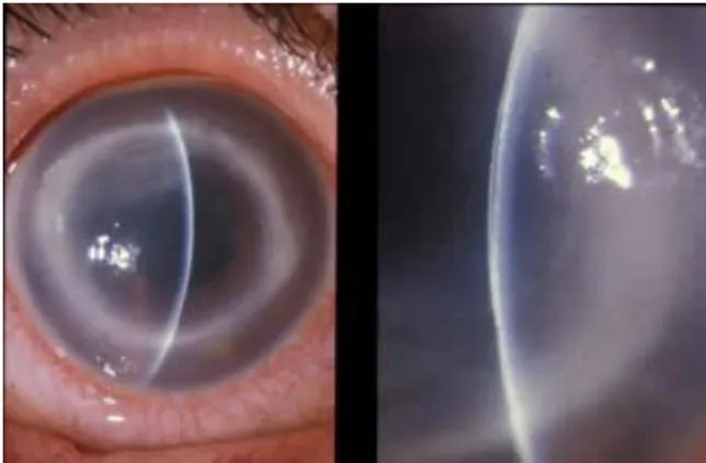 Gambar 10. Acanthamoeba keratitis 27