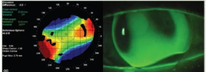 Gambar 12. Corneal Warpage 29