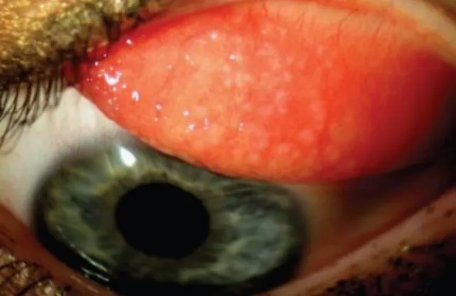 Gambar 4. Giant Papillary Conjuctivitis  (GPC) 22