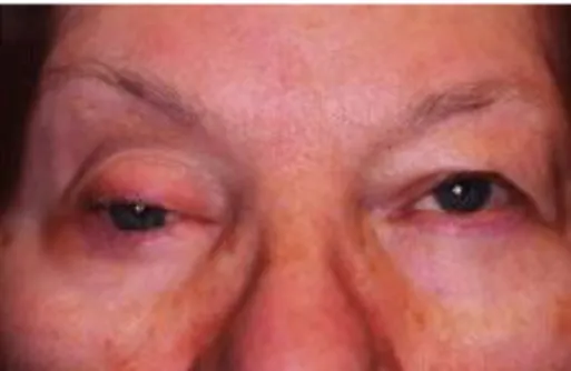 Gambar 5. Ptosis 23