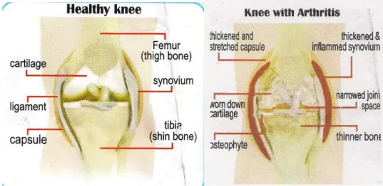Gambar 1. A Kiri : Gambar Sendi Lutut Normal.B. Kanan :gambar  sendi lutut yang mengalami  osteoartritis