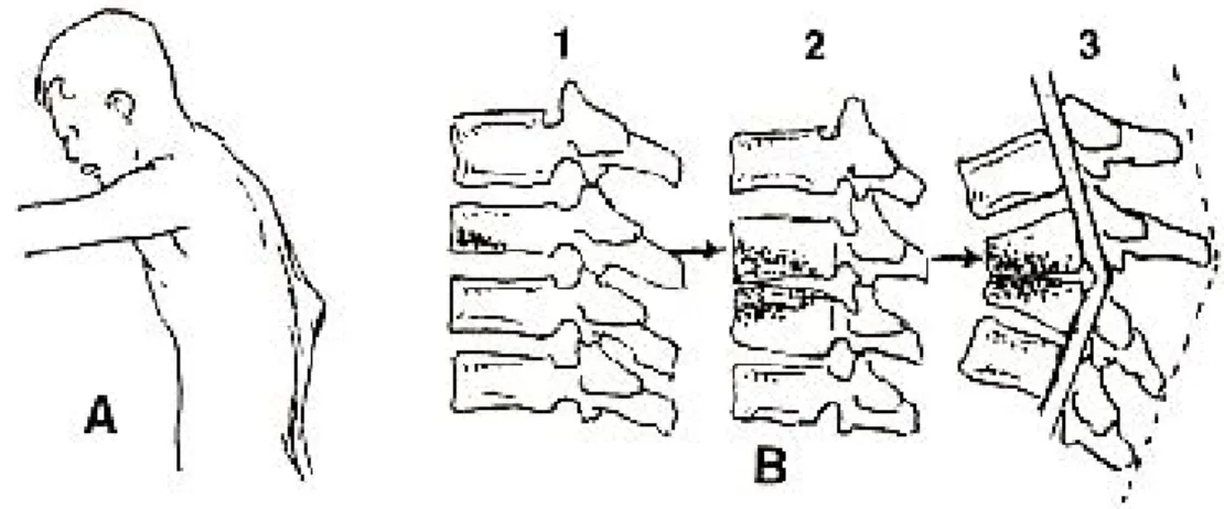 Gambar  3.  Spondilitis  tuberkulosis.  A)  Gibus  thorakolumbar  dengan  hipertonus  erektor  trunkus