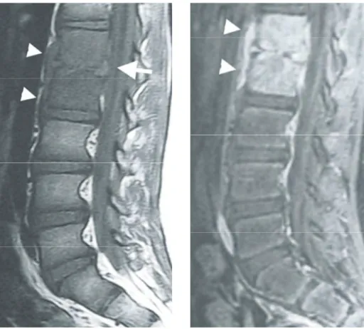 Gambar 1 PD pada pasien laki-laki 38 tahun. (a) Foto Ro Torakolumbal AP menunjukkan penurunan tinggi korpus vertebrae Th9(*), hilangnya struktur diskus dan iregularitas di Th8/Th 9