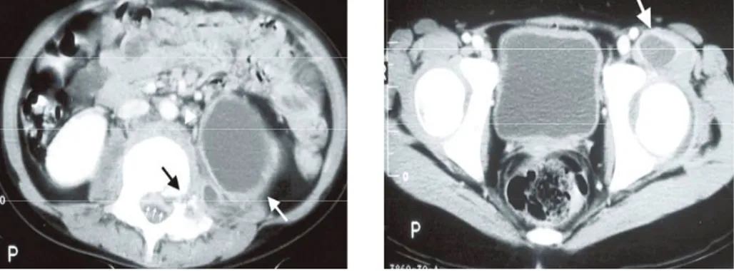 Gambar 4 Keterlibatan struktur posterior pada PD di  vertebrae servikalis-2 pada potongan aksial CT Scan  ditandai sklerosis reaktif dan destruksi segmen anterior dan  posterior