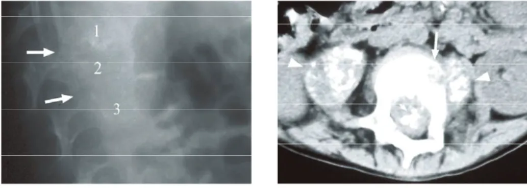 Gambar 8 Kolaps korpus vertebrae pada anak 10 tahun dengan PD pada L1-3. (a) Foto Ro Lumbal lateral menunjukkan  kolaps vertebrae L1-3