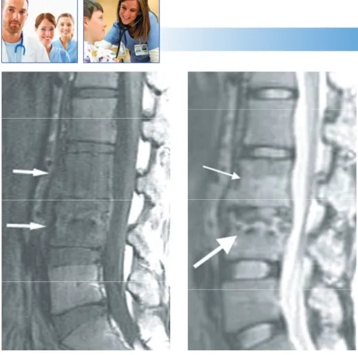 Gambar 12 Gambaran MR pada PD stadium awal. (a) Potongan sagital T1 menunjukan korpus vertebrae L3-L4 hipointens  (anak panah) karena keterlibatan medula spinalis