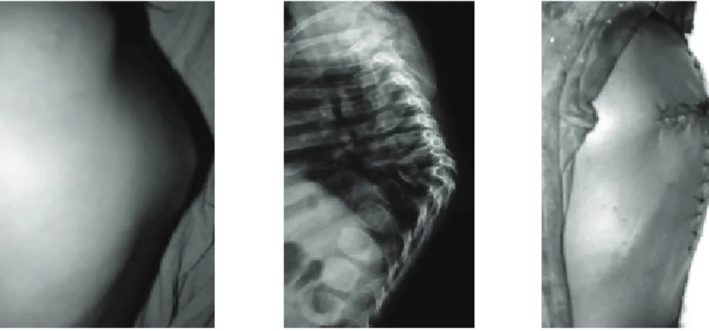 Gambar 14 (a) Klinis anak usia 3 tahun dengan PD, menunjukkan deformitas kifosis berat vertebrae torakalis