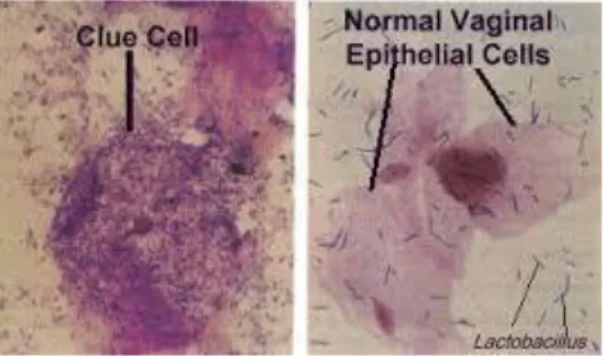 Gambar 4. Clue cell pada BV dan sel epitel normal vagina. 